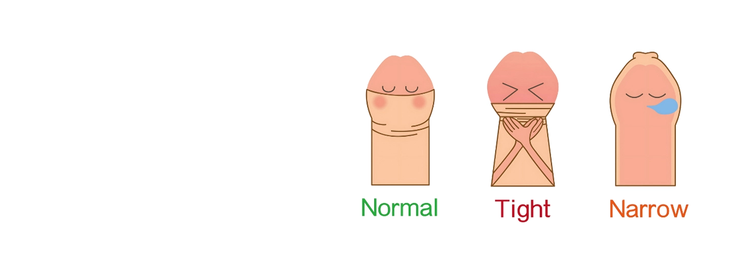 Phimosis (Tight Foreskin): Symptoms and Treatment Options
